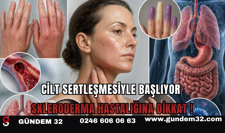 Cilt Sertleşmesiyle Başlıyor: Skleroderma Hastalığına Dikkat !