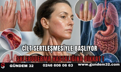 Cilt Sertleşmesiyle Başlıyor: Skleroderma Hastalığına Dikkat !